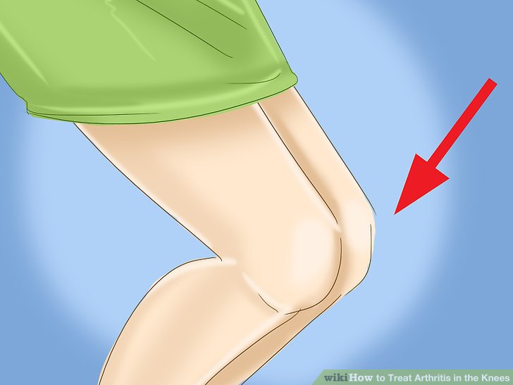 Name:  aid4594160-v4-728px-Treat-Arthritis-in-the-Knees-Step-5-Version-2.jpg
Views: 790
Size:  34.8 KB